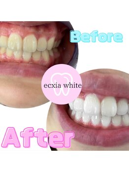 エクシアホワイト 広島袋町店/ホワイトニングビフォーアフター
