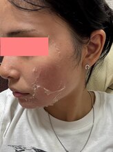 アンテサロン 関内店(Antesalon)/剥離ハーブピーリングDT：1