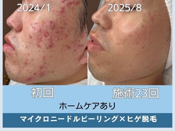 アロマ(AROMA)/凹凸跡/毛穴/越谷せんげん台