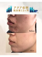 ラヴレボーテ(La Vraie Beaute)/自己症例