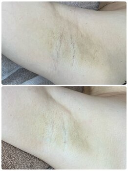 フローレ 平針店(Flore)/ボディの黒ずみや色素沈着にも