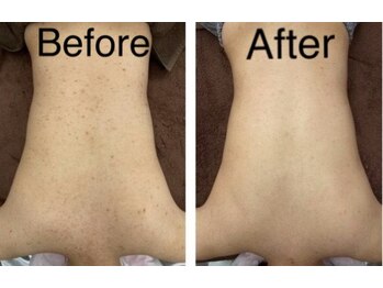 ケイビューティーサロン(K BeautySalon)/夏前に背中美人に目指しましょう