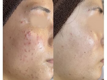 エヌエースキン たまプラーザ店(NAskin)/ハーブピーリング|ニキビケア