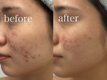 ルテア(Retea.)/【ニキビケア】光フェイシャル