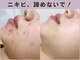 ロエヴェ(ROEWE)の写真/ピーリングでも改善しなかった方!繰り返すニキビを改善!肌を｢変える/守る/育てる｣独自技術で本気の肌質改善