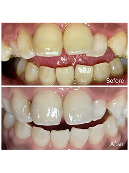 フィールグルック(Viel Gluck)/プレミアムセルフホワイトニング