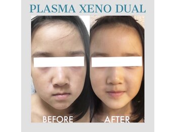 ビーダブリュー(BW...)/☆プラズマゼノデュアル施術例☆