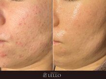 レロ 恵比寿店(LELLO)の雰囲気（【赤みとごわつき】お肌が柔らかくなり見た目も肌触りも滑らかに）