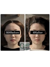 キュープ 松戸店(Qpu)/小顔頭蓋骨矯正