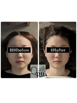 キュープ 松戸店(Qpu)/小顔頭蓋骨矯正