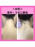 【女性脱毛】実は見られている！うなじ＆背中　似合わせシェービング付き