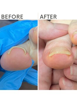 クオッカ(Quokka)/巻き爪ケア