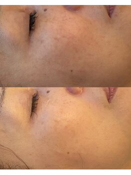 彌庵/シミケア　症例