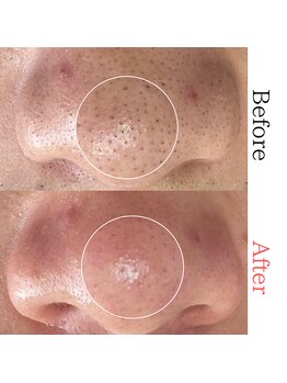 ボータン 恵(Beau Temps)/毛穴ケア/毛穴洗浄　【施術例】