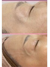 カブール 町田/たった2か月でちりめんじわ改善!