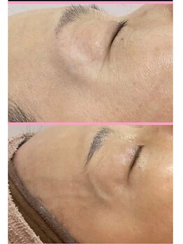 カブール 町田/たった2か月でちりめんじわ改善!