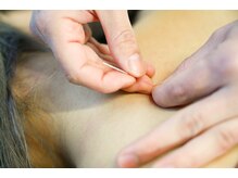 中村温灸院/刺さない鍼