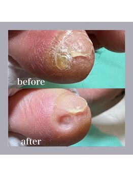 巻き爪補正店 天王寺店/痛い小指、魚の目かも!?