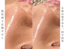 ファシネアオヤマ(FACINE AOYAMA)/小鼻の黒ずみも一回で改善！