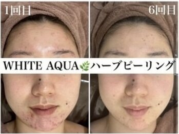 ホワイトアクア 四日市店(WHITE AQUA)/ハーブピーリングビフォーアフタ