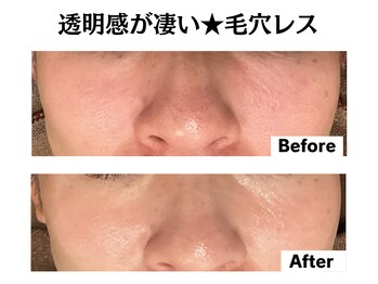 グレースティー 森町 箕面/透明感！最強美肌★毛穴レス肌へ