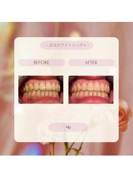プラスビーセルフ(+b self)/ホワイトニングビフォーアフター