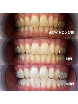 ホワイトニングビューティー 行橋店/初めてのホワイトニング