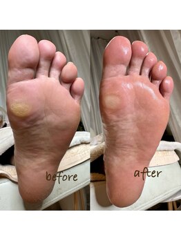 歩くと痛いタコ