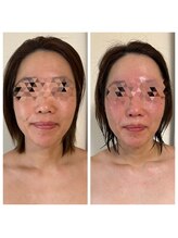 ヨサパーク リアン(YOSA PARK Lien)/モニター様before→after/痩身