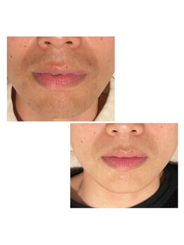 リモアボーテ(RIMOA beaute)/ヒゲ脱毛