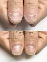 マリーロール 梅田店(Marie Laure)/自爪育成/深爪矯正/ネイルケア