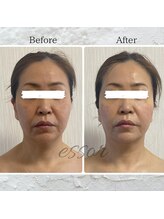 エソール(essor)/リアボーテハーブピーリング