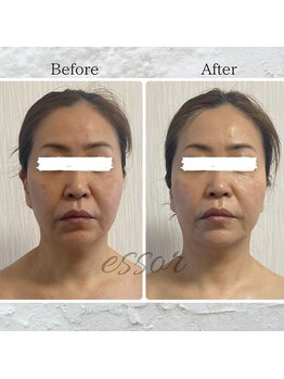 エソール(essor)/リアボーテハーブピーリング