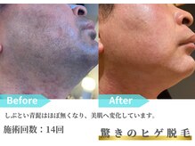 プラスワン/ヒゲ脱毛の効果