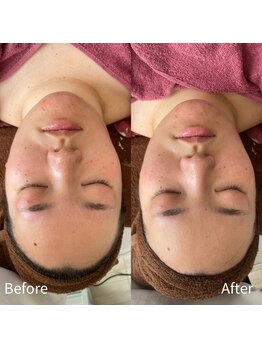 ビトタン 倉敷本店(+美to鍛)/ハーブピーリング1g/1回