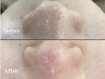 ワイスリー(Y3)/水素毛穴洗浄コース