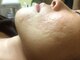 ノットノット 自由が丘(Not Knot)の写真/気になる毛穴の開き、繰り返すブツブツ肌、凸凹肌、様々な肌悩み、ニキビにお悩みの方にオススメ♪