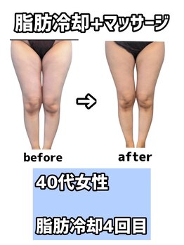 rvコーディネイトサロン(rv coordinate salon)/脂肪冷却の症例です(^^♪