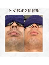 ボゴス(BOGOSS)/ヒゲ脱毛3回照射