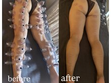 ミイン(miin)/カッピング吸引施術