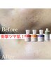 【本気の肌質改善☆】皮脂のバランス美肌シェービング60分￥14,850→￥9,900