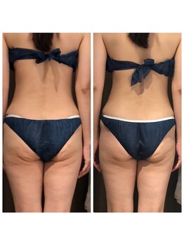 すっぴん美肌革命/セル脂肪撃退!美尻に近づきます