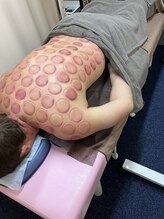 仁接骨院 じん鍼灸治療院/カッピング施術例