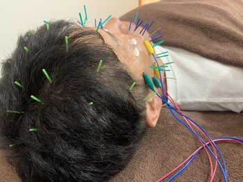 サプル(supple)/【美容鍼灸】メンズ様にも