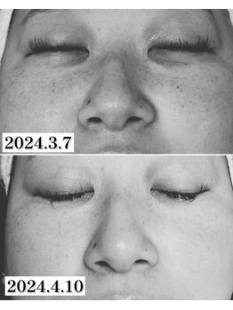 ミナミ(MINAMI)/シミケア1回＋赤ら顔オプション