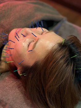 宮町鍼灸整骨院/リフトアップでお顔すっきり♪