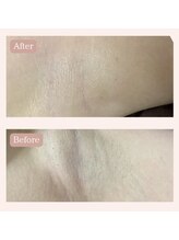 リードエピア(LEADepiA)/ワキ脱毛のビフォーアフター