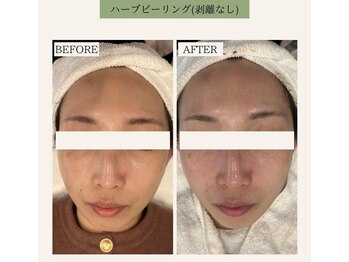 ベル 下北沢(Belle)/ハーブピーリング【ソフト】