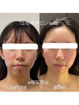 ソラ(sola*)/フェイスラインが違えば垢抜ける