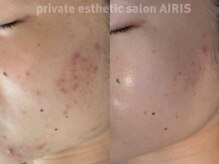 ハーブピーリングで毛穴改善、ニキビケア、美白お任せください♪